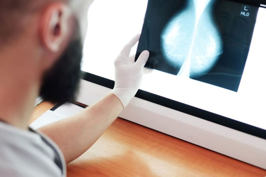 Mamografía analizada por IA mostrando detección temprana de tumor con precisión récord en estudio masivo