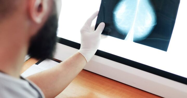 Mamografía analizada por IA mostrando detección temprana de tumor con precisión récord en estudio masivo