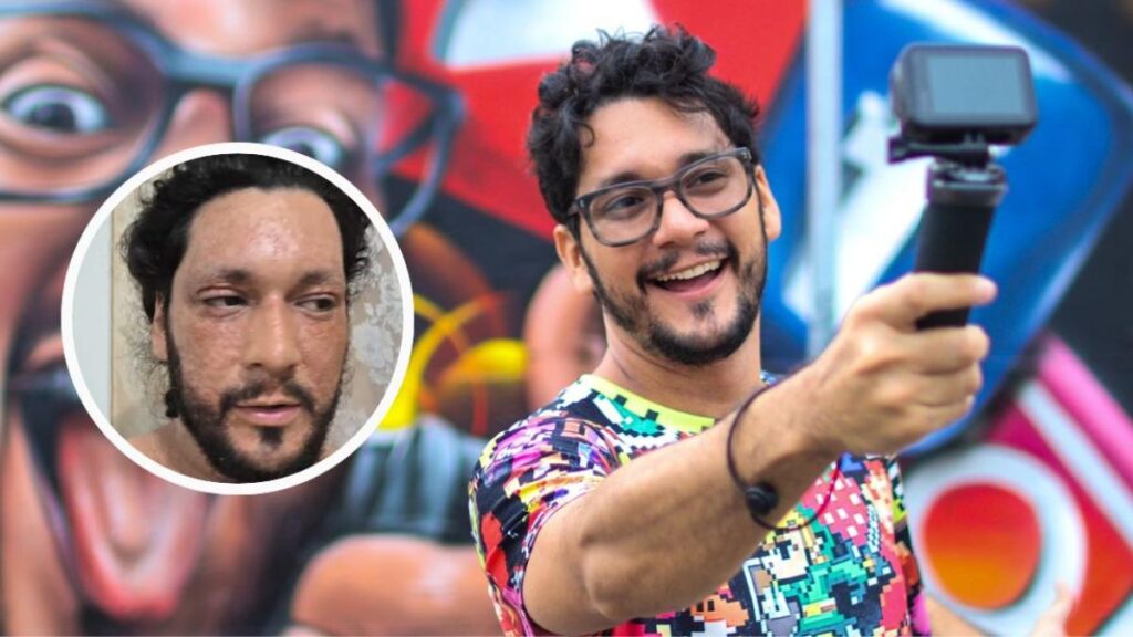 Felipe Crespo muestra rostro con marcas de dermatitis atópica en transmisión en vivo con expresión de dolor