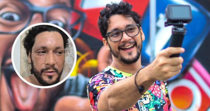 Felipe Crespo muestra rostro con marcas de dermatitis atópica en transmisión en vivo con expresión de dolor