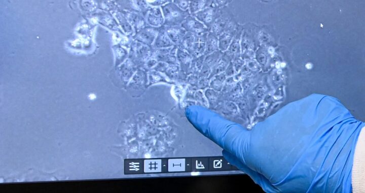 Escáner de tomografía con IA Redmod analizando patrones ocultos de cáncer de páncreas en etapa inicial